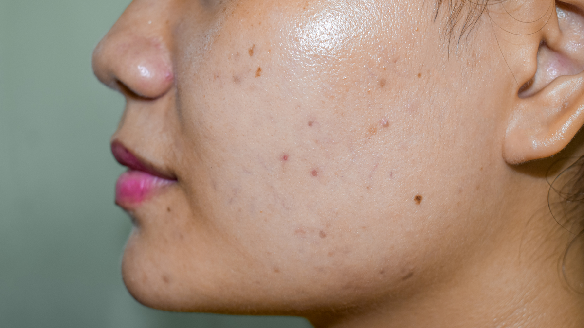 Does Vitamin C Help With Dark Spots?
