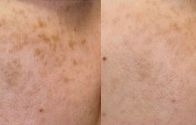 Helped My Skin Recover